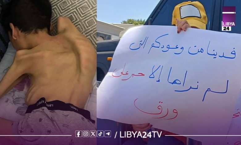 مرضى ضمور العضلات